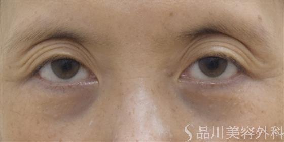 症例NO.52197のBEFORE写真