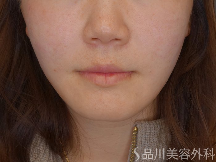 症例NO.72708のAFTER写真