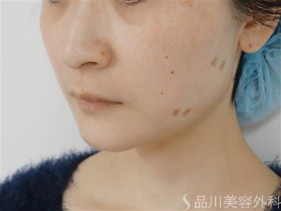 症例NO.31369のAFTER写真