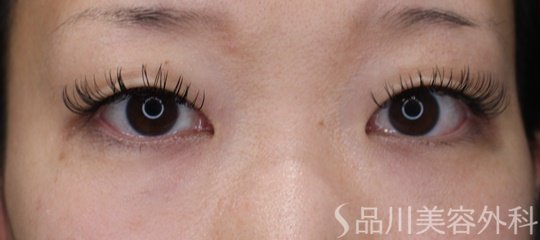 症例NO.70062のBEFORE写真