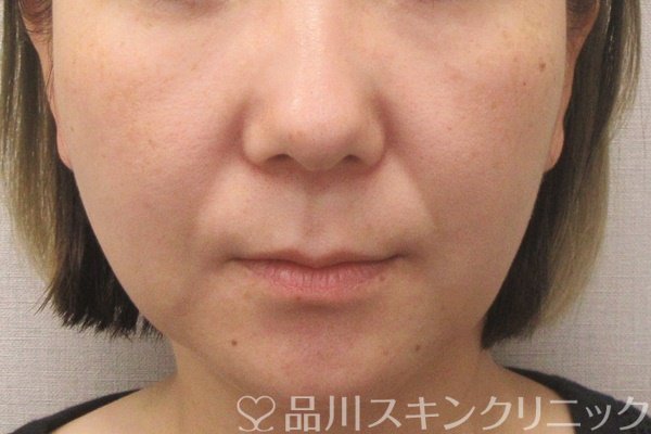 症例NO.70410のBEFORE写真