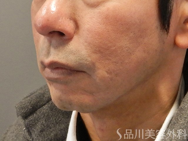 症例NO.73876のBEFORE写真