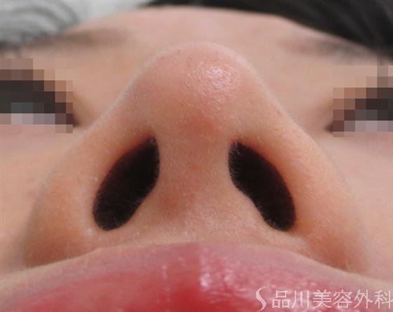 症例NO.22125のAFTER写真