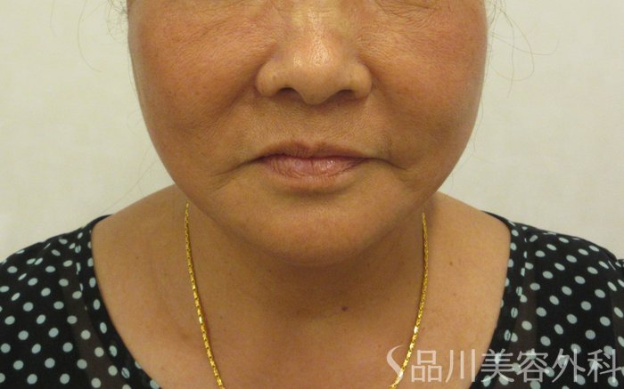 症例NO.72131のAFTER写真