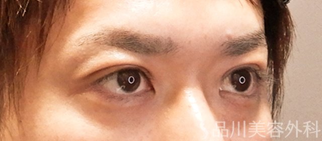 症例NO.70985のAFTER写真