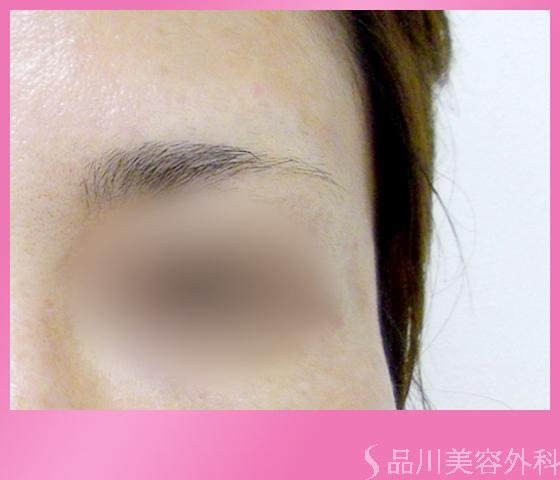 症例NO.1165のAFTER写真