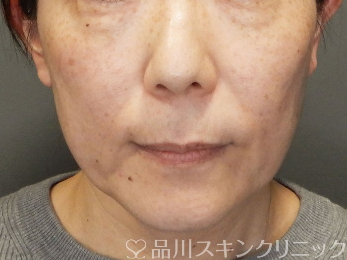 症例NO.70301のBEFORE写真