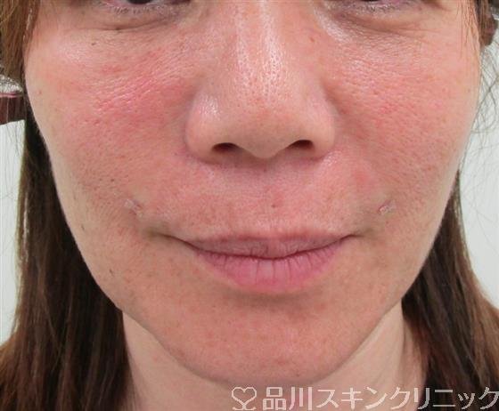 症例NO.30748のAFTER写真