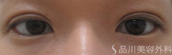 症例NO.18110のAFTER写真