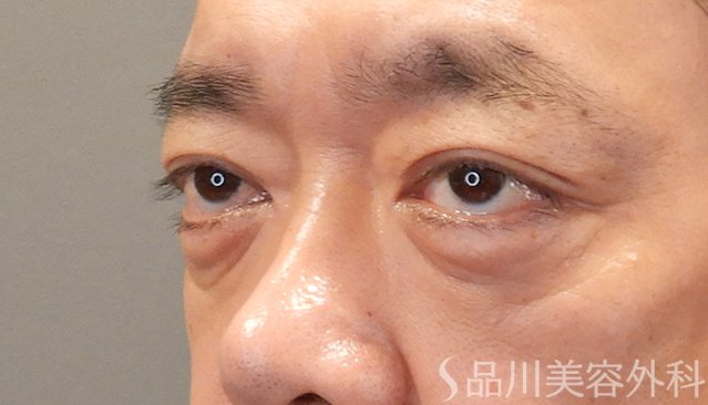 症例NO.75042のAFTER写真