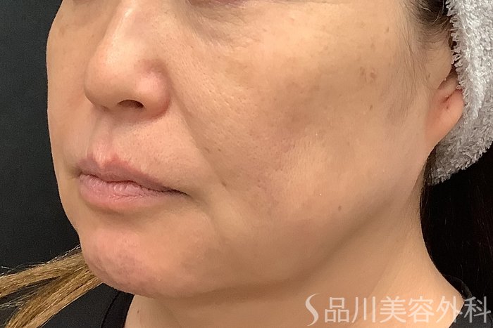 症例NO.71251のBEFORE写真