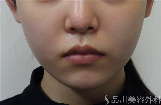 症例NO.53362のBEFORE写真