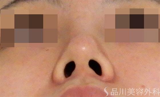症例NO.38736のAFTER写真