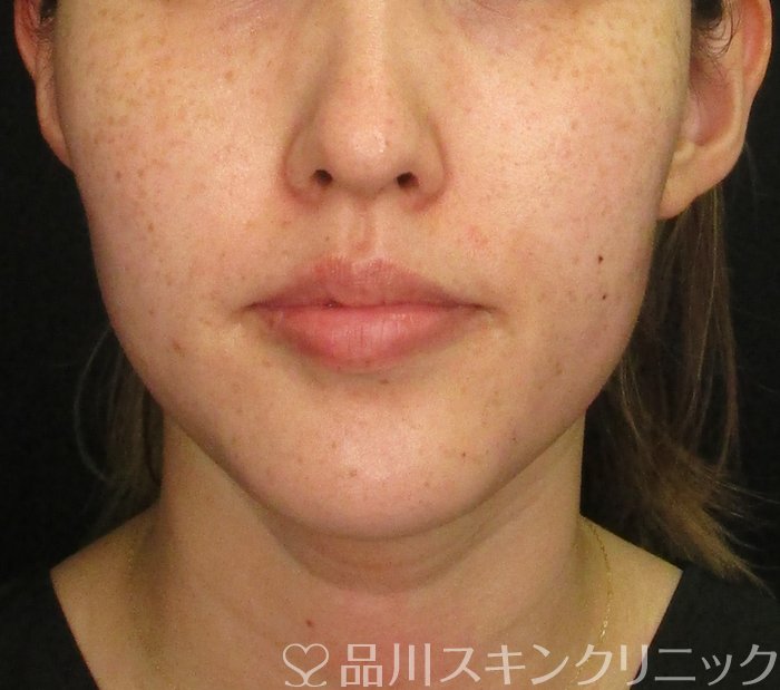 症例NO.73967のBEFORE写真