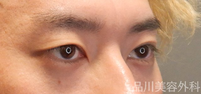 症例NO.72151のBEFORE写真