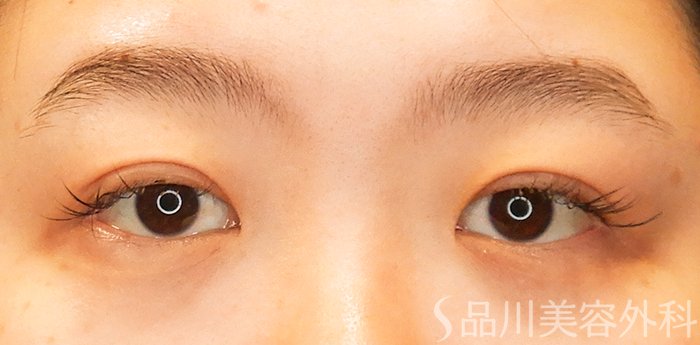 症例NO.67067のAFTER写真