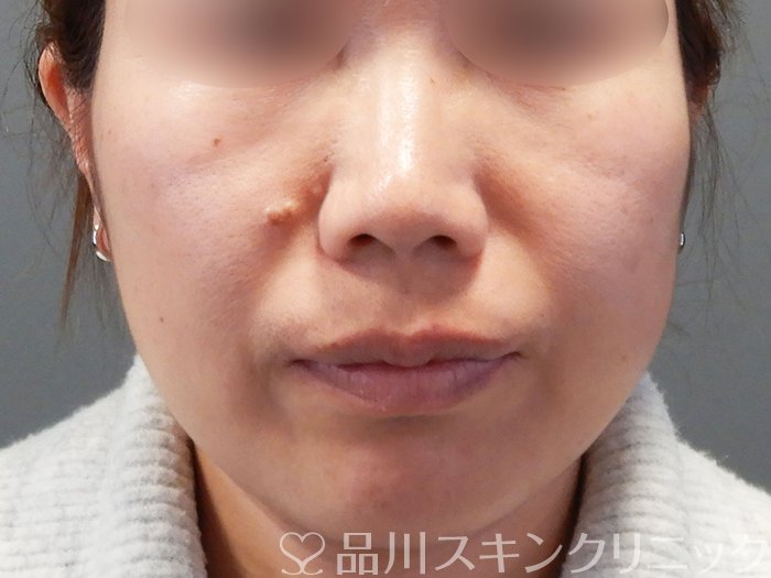 症例NO.73241のBEFORE写真