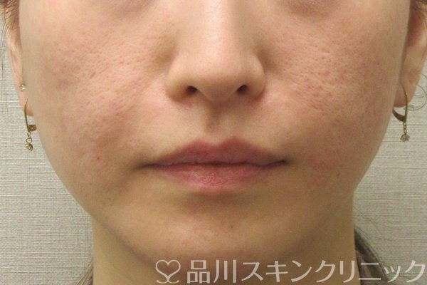 症例NO.72746のAFTER写真