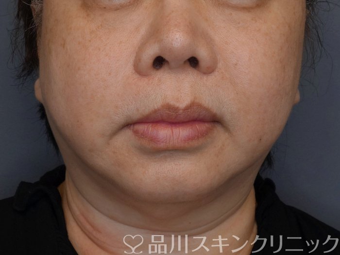 症例NO.74446のBEFORE写真