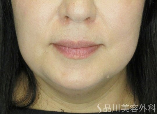 症例NO.71418のBEFORE写真