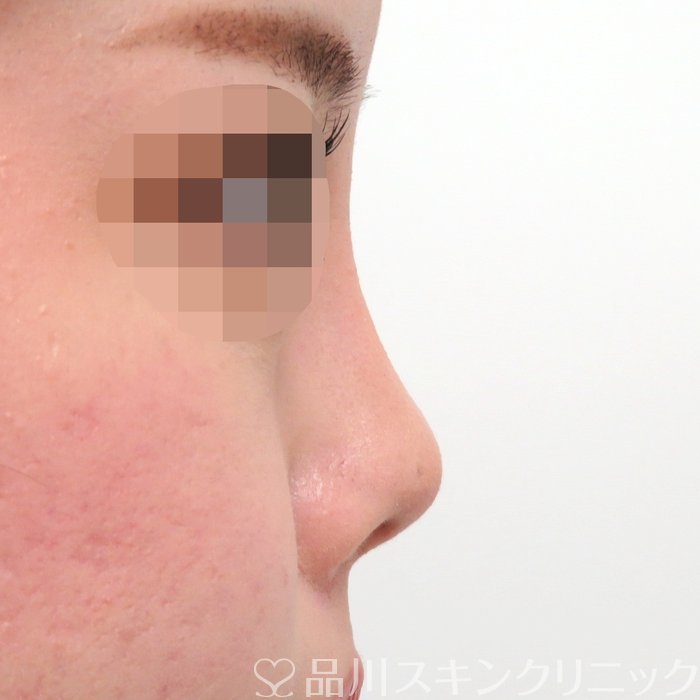 症例NO.71290のAFTER写真
