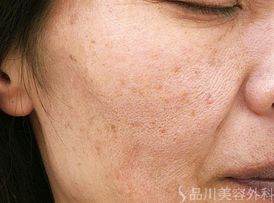症例NO.23671のBEFORE写真
