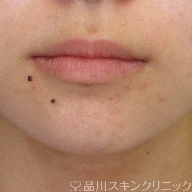 症例NO.69992のBEFORE写真