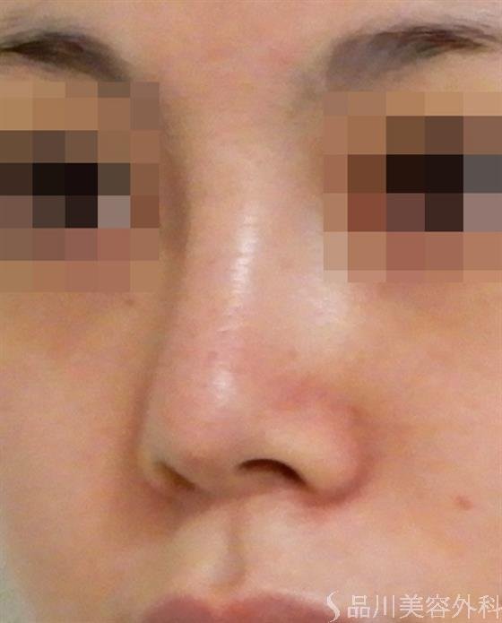 症例NO.38736のAFTER写真