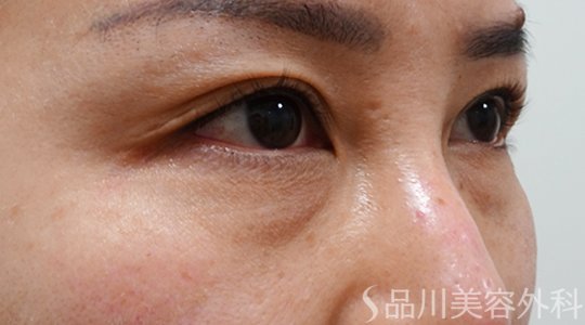 症例NO.70207のBEFORE写真