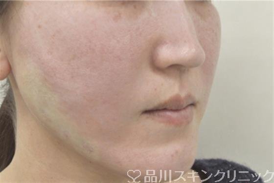 症例NO.31244のAFTER写真