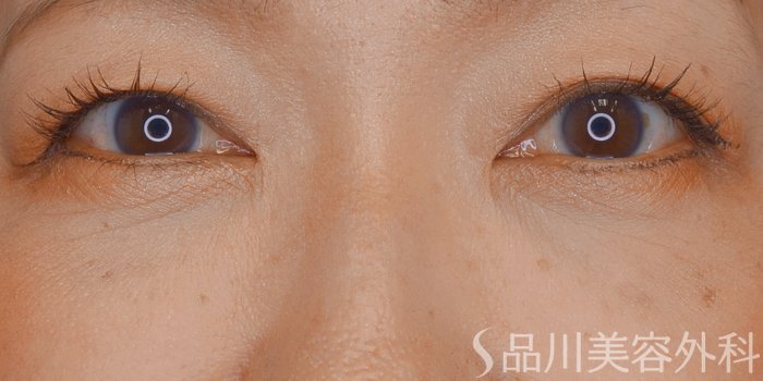 症例NO.71746のAFTER写真