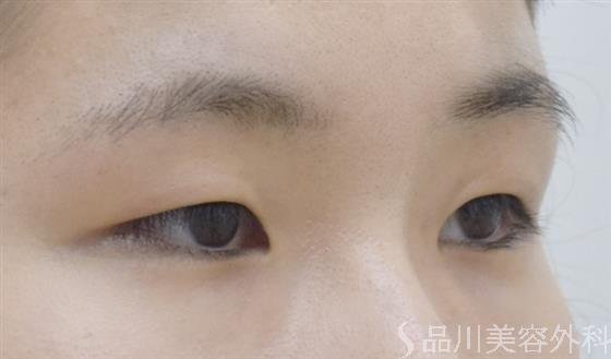 症例NO.54040のBEFORE写真
