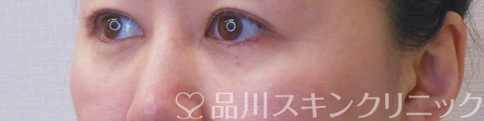 症例NO.71412のAFTER写真