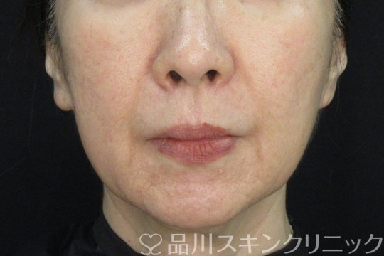 症例NO.72174のAFTER写真