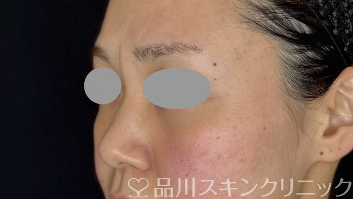 症例NO.67970のBEFORE写真