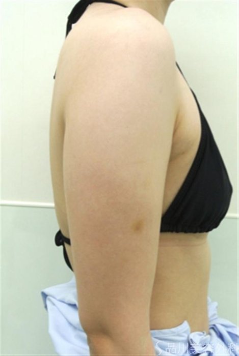 症例NO.17209のBEFORE写真