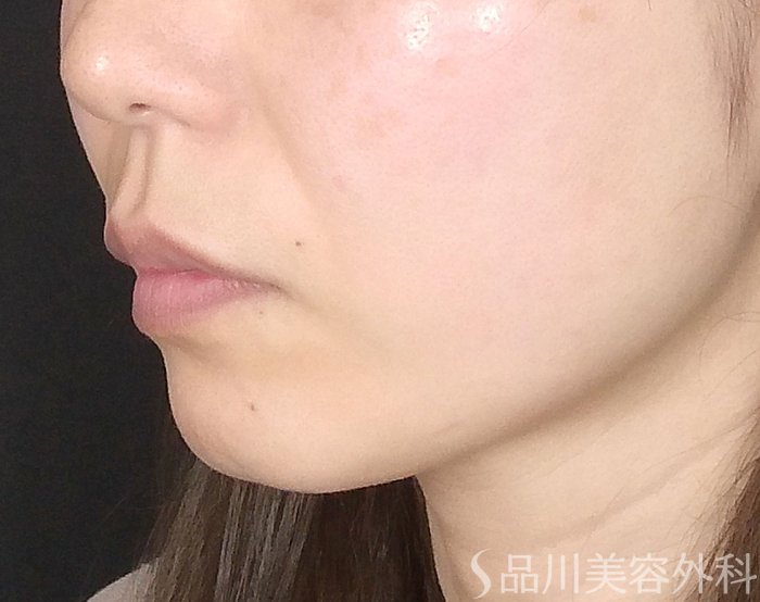 症例NO.69329のBEFORE写真