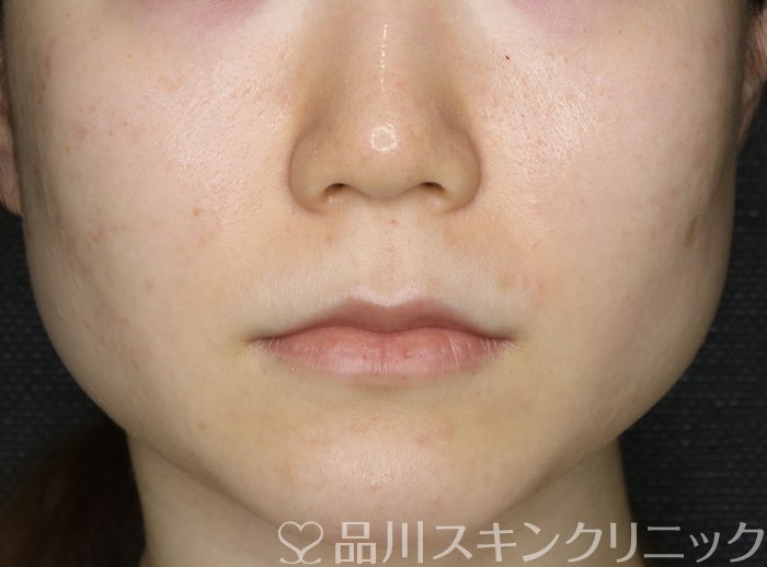 症例NO.70467のBEFORE写真
