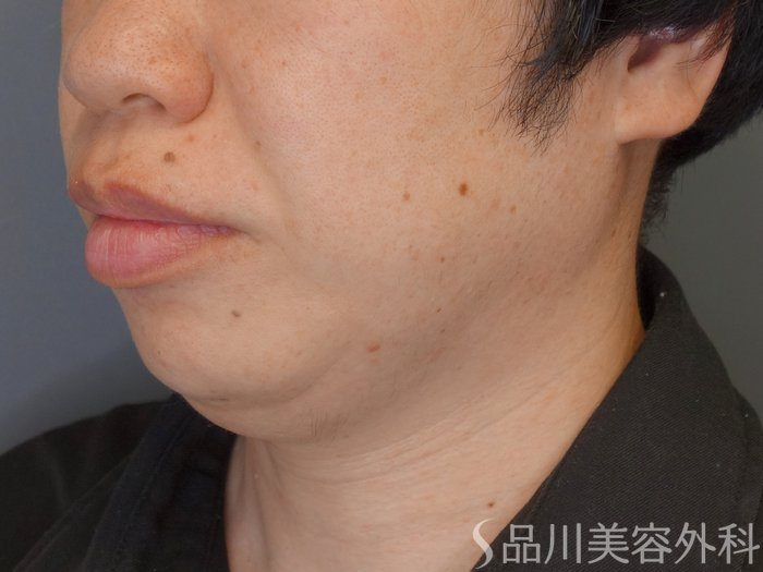 症例NO.70745のBEFORE写真