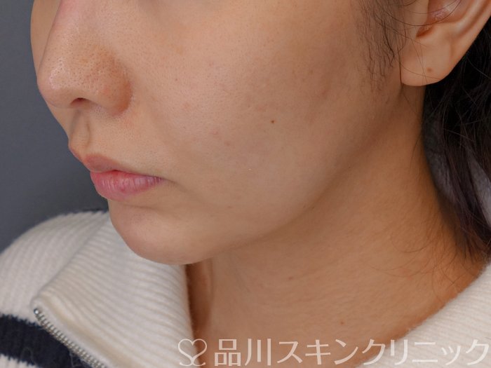 症例NO.72303のBEFORE写真