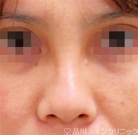症例NO.44673のAFTER写真