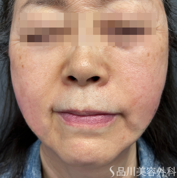 症例NO.65014のAFTER写真