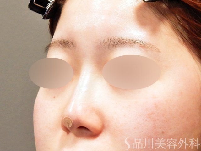 症例NO.69297のAFTER写真