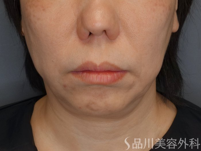 症例NO.72987のBEFORE写真