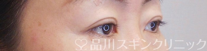 症例NO.70940のAFTER写真
