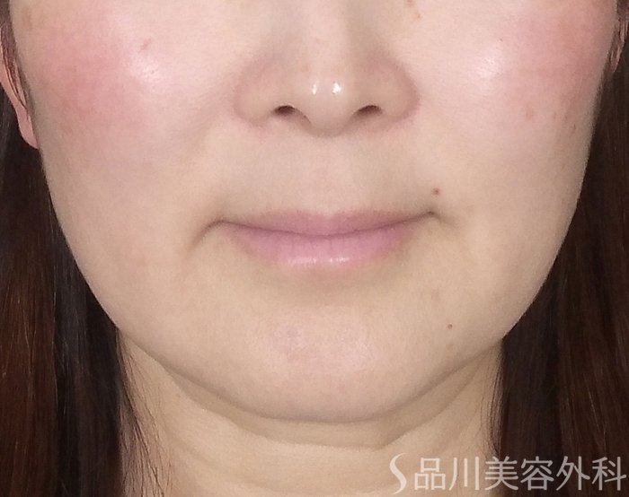 症例NO.69465のBEFORE写真
