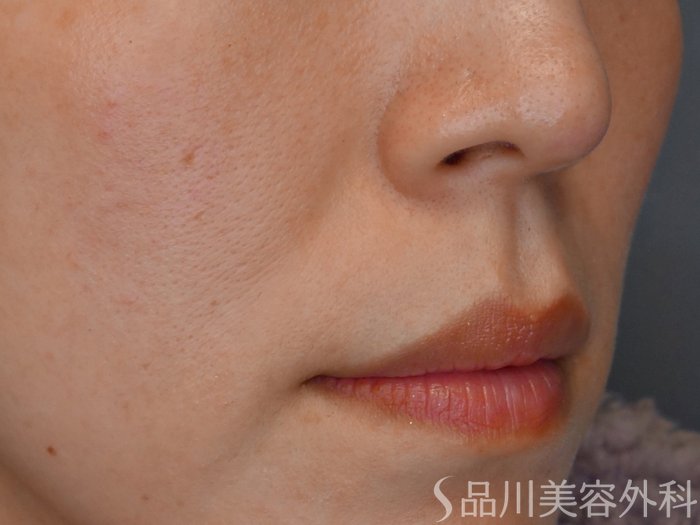 症例NO.68464のBEFORE写真