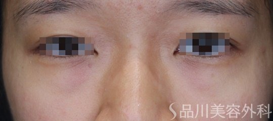 症例NO.64462のBEFORE写真