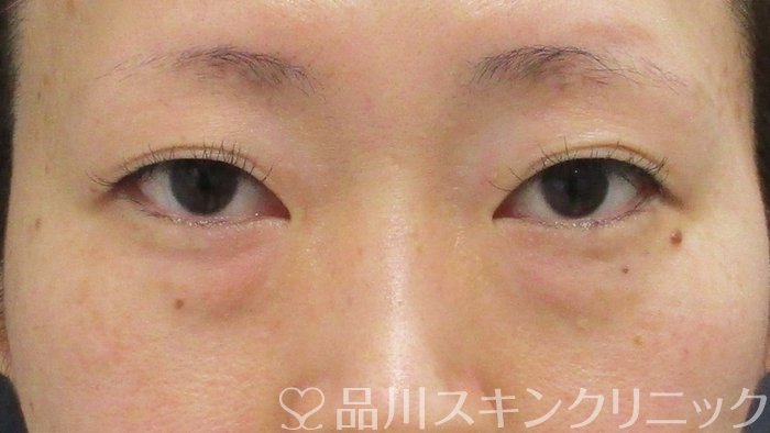 症例NO.70064のBEFORE写真