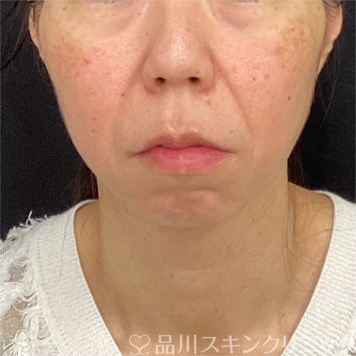 症例NO.70163のBEFORE写真